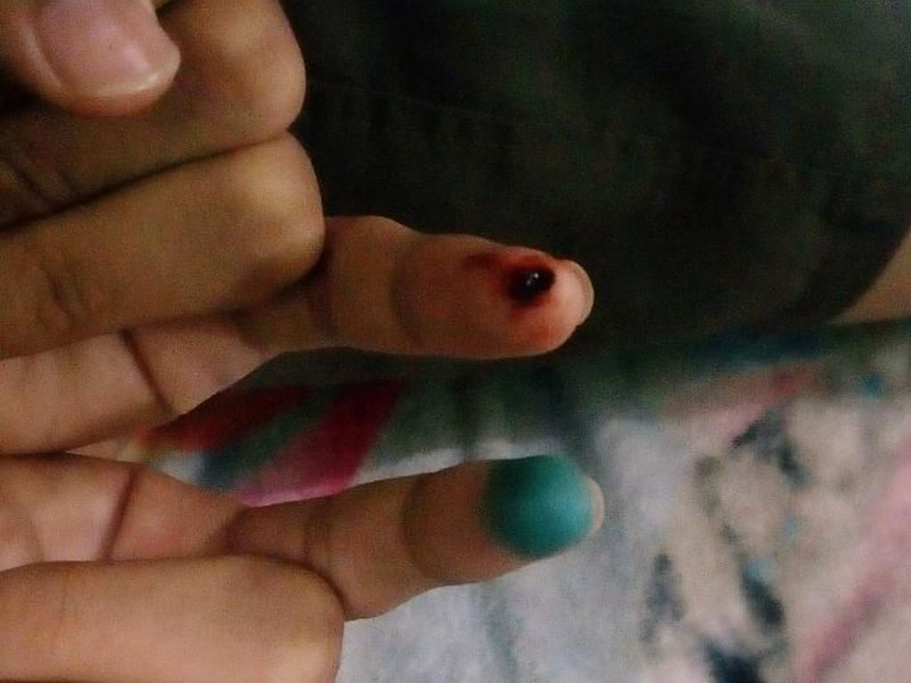 Kena Hernia, Pasien ini Coba Terapi Sujok Tinta Spidol Kena Hernia, Pasien ini Coba Terapi Sujok Tinta Spidol