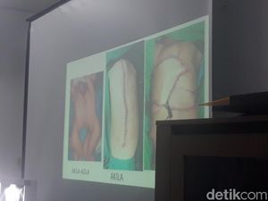 Kembar Siam Asal Kendari Dipasang Plat Pengganti Tulang Dada