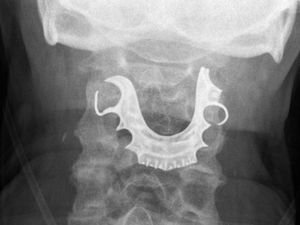 Sulit Menelan, Ternyata Ada Serangkaian Gigi Palsu di Tenggorokan Pria Ini