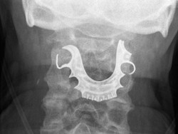 Sulit Menelan, Ternyata Ada Serangkaian Gigi Palsu di Tenggorokan Pria Ini