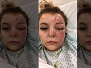 Telur Yang Dimasak Meledak, Wanita Ini Alami Luka Bakar Serius Telur Yang Dimasak Meledak, Wanita Ini Alami Luka Bakar Serius