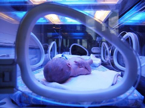 Bilirubin Tinggi Penyebab Bayi Kuning di Minggu Awal Kelahirannya
