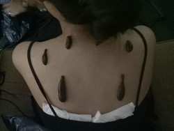 Sakit Kepala Terus Menerus, Ini Pengalaman Fatima Jajal Terapi Lintah