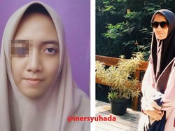 Viral di Medsos, Ini Kisah Ine Pengidap Sindrom Marfan