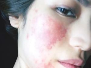 Hiks, Jessica Iskandar Harus Cuti Kerja Gara-gara Ruam di Wajah Hiks, Jessica Iskandar Harus Cuti Kerja Gara-gara Ruam di Wajah