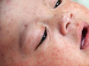 4 Negara Eropa Tak Lagi Bebas Campak Meski Tingkat Vaksinasi Tinggi