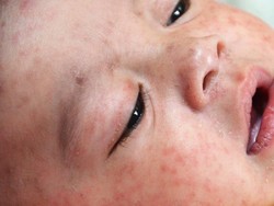 4 Negara Eropa Tak Lagi Bebas Campak Meski Tingkat Vaksinasi Tinggi