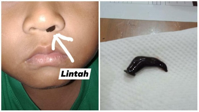 Potret lintah hidup yang diambil dari hidung anak Puji. (Foto: Facebook/Setyo Pe-je Chelsea)