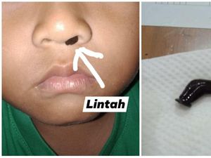 Viral Lintah Hidup Bersarang di Hidung Anak 4,5 Tahun dari Solo Viral Lintah Hidup Bersarang di Hidung Anak 4,5 Tahun dari Solo