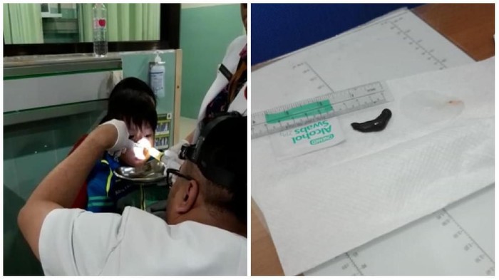Lintah yang berhasil dikeluarkan dari hidung anak. (Foto: dok.pribadi/Puji)