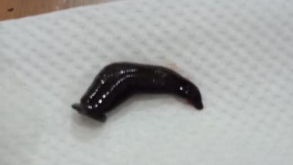 Potret Lintah yang Viral Hidup di Hidung Bocah Asal Solo