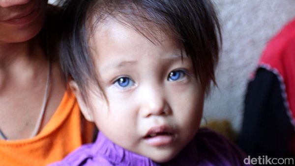 Sosok Balita di Bandung yang Memiliki Bola Mata 3 Warna