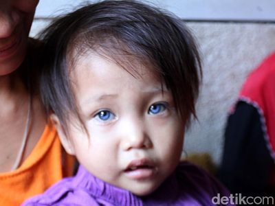 Sosok Balita di Bandung yang Memiliki Bola Mata 3 Warna