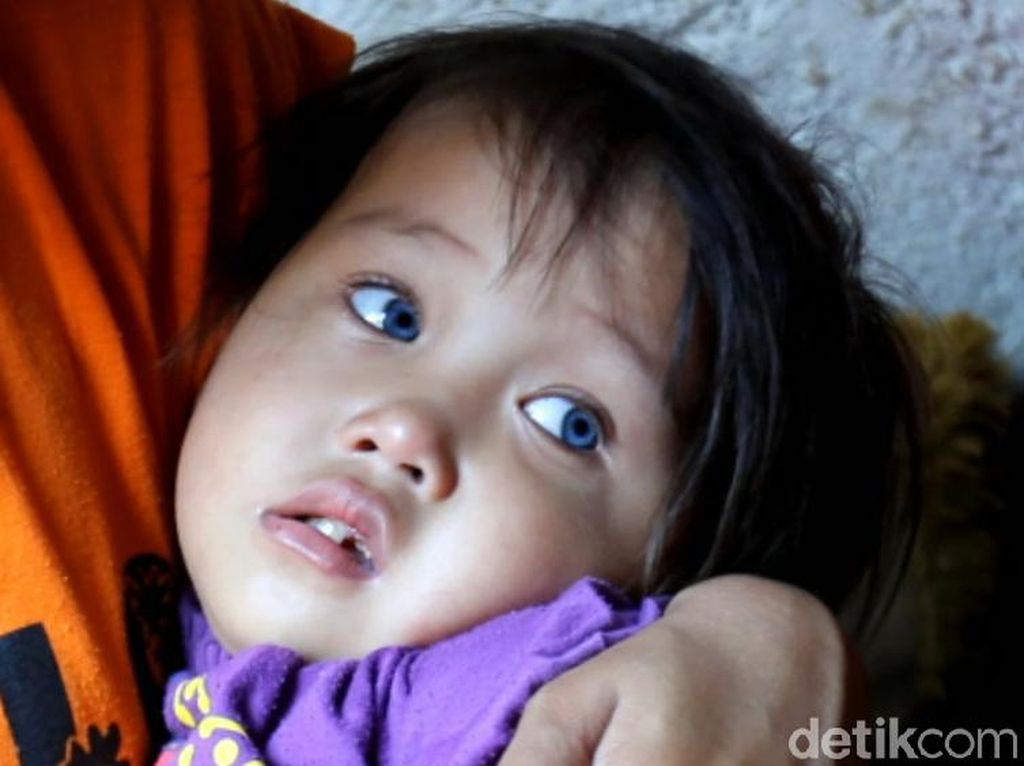 Kata RS Mata Cicendo Soal Mata Bocah Amelia yang Bisa Berubah Warna Kata RS Mata Cicendo Soal Mata Bocah Amelia yang Bisa Berubah Warna
