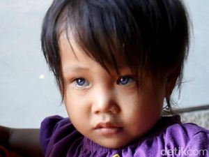 Efek Pembiasan, Bocah dengan Mata Berubah 3 Warna Termasuk Kondisi Langka Efek Pembiasan, Bocah dengan Mata Berubah 3 Warna Termasuk Kondisi Langka