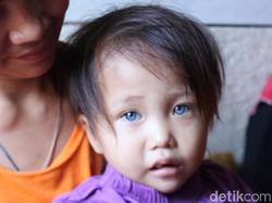 Soal Mata Bocah di Bandung Berubah 3 Warna, Ini Kata Dokter