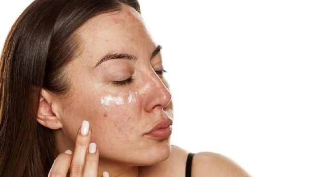 ilustrasi melasma
