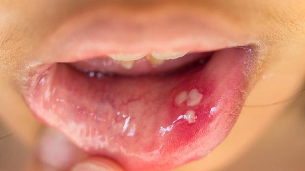 mouth ulcer or canker sore or aphthous stomatitis or  aphthous ulcer
