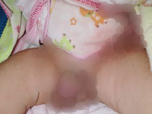 Bayi di Lombok Lahir dengan Penis Sudah Disunat