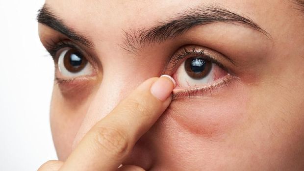 close up of woman show her red sick eye with finger