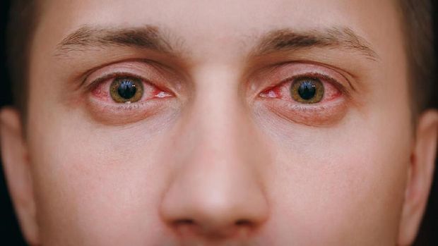 The close up of two annoyed red blood eyes of a man affected by conjunctivitis