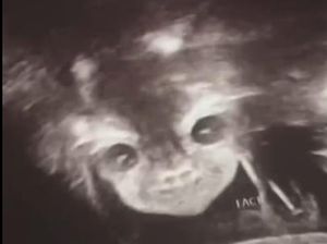 Viral Foto USG Bayi Disebut Mirip Setan, Sang Ibu Tetap Mencintainya