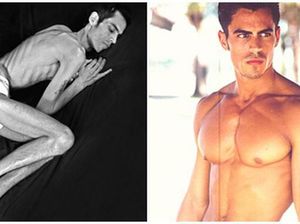 Tinggal Tulang dan Kulit, 5 Kasus Gangguan Makan Anoreksia Ini Bikin Ngeri