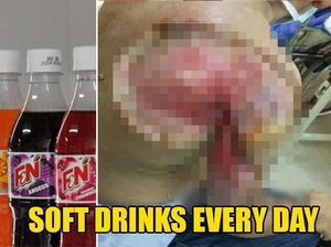 Rutin Minum Soda Tiap Hari, Pria di Malaysia Ini Nyaris Kehilangan Lengannya