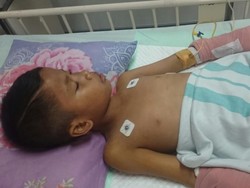 Ahmad Dani Jalani Perawatan di Surabaya Karena Alami Luka Bakar