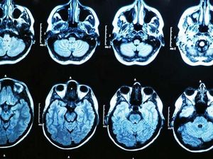 Dikira Serangan Rahasia, Penyakit Misterius di Kuba Disebabkan Pestisida