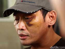 Buka-bukaan Tersangka Penganiaya Ninoy Karundeng