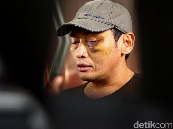 Babak Belur, Ninoy Karundeng Bicara Soal Penganiayaan Dirinya
