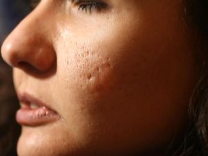 Inovasi Terapi Laser & Skin Booster Terbaru, Hilangkan Bopeng Secara Permanen Inovasi Terapi Laser & Skin Booster Terbaru, Hilangkan Bopeng Secara Permanen