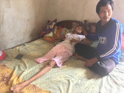 Siswi SMP Penderita Kanker Tulang Butuh Kaki Palsu, Ini Janji Pemkab Mojokerto