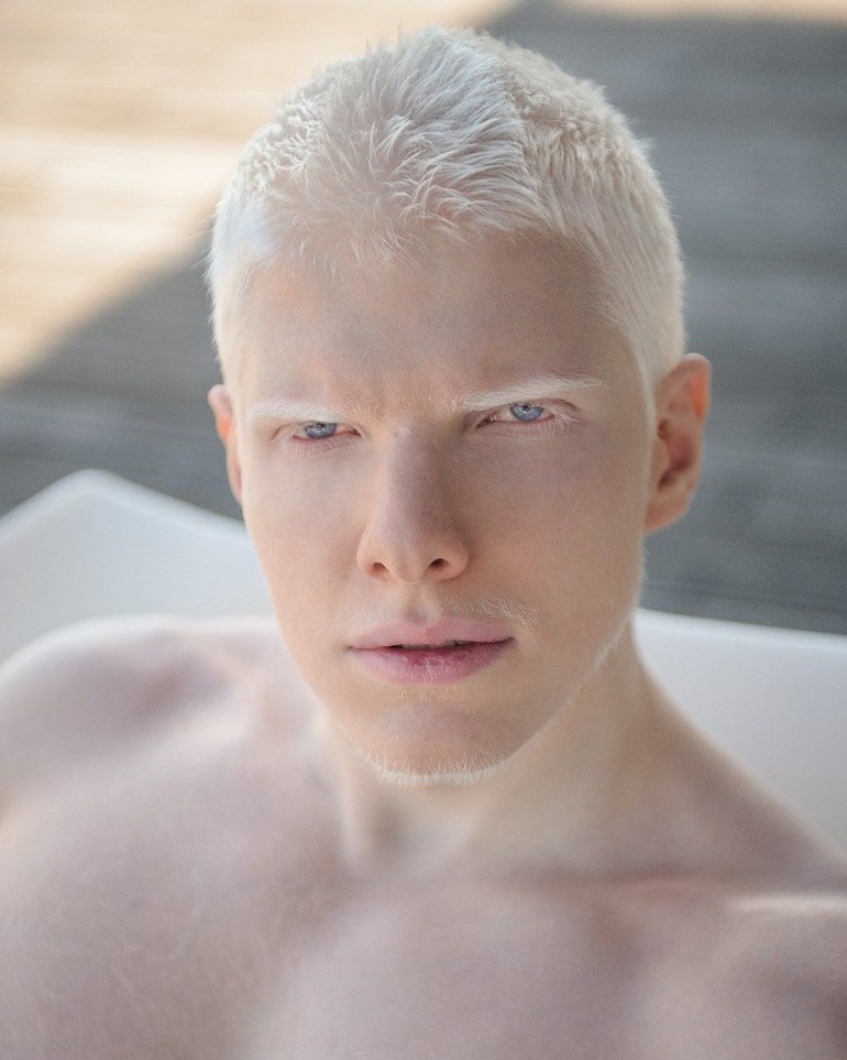 Kondisinya sebagai albino membuatnya terkenal. 