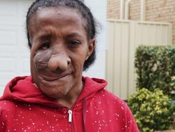 Perempuan Asal Jayapura Natalia Apaseray Operasi Tumor Wajah di Sydney