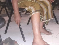 Terperosok Lubang Bara, Kaki Pemadam Kebakaran Gunung Ringgit Melepuh