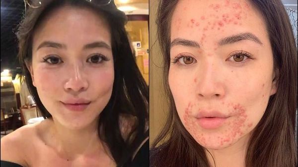 Presenter Berita Ini Tetap Percaya Diri Meski Alami Kondisi Jerawat Misterius