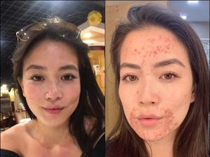 Presenter Berita Ini Tetap Percaya Diri Meski Alami Kondisi Jerawat Misterius