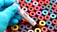 Muncul Kasus Polio pada Anak di Purwakarta, Pasien Alami Kelemahan Otot Kaki