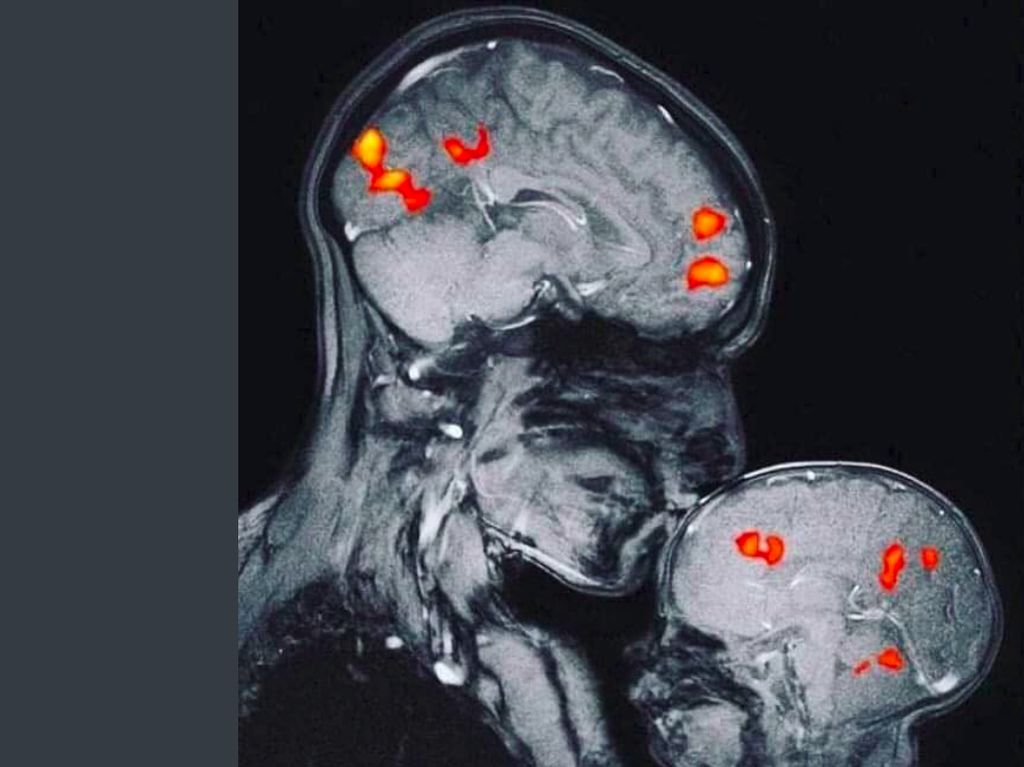 Viral Foto MRI Otak Bukti Kasih Sayang Ibu dan Anak, Ini Faktanya