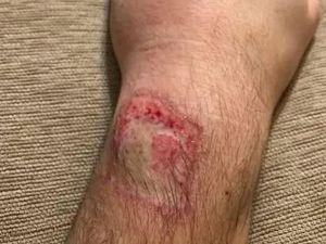 Jam Pintar Meledak di Tangan Saat Tidur, Korban Luka Bakar