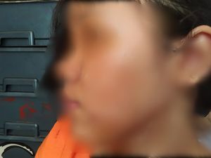 Siswi SMP Korban Penyiraman Air Keras: Aku Tak Ada Masalah Sama Orang