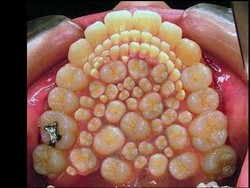 Foto Mengerikan Mulut dengan 232 Gigi karena Kondisi Langka, Asli atau Hoax?