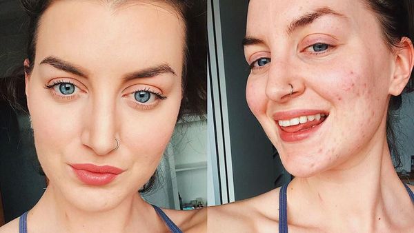 Potret Wanita yang Sembuh dari Jerawatan Parah Hanya dengan Ubah Mindset