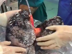 Viral Paru-paru Menghitam karena Puluhan Tahun Merokok, Kok Bisa?