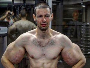 Pria Ini Terobsesi Mirip Popeye, Berakhir Tragis karena Ototnya Jadi Busuk Pria Ini Terobsesi Mirip Popeye, Berakhir Tragis karena Ototnya Jadi Busuk