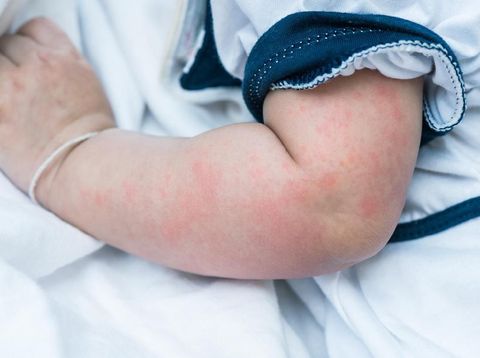 Close up image of baby skin texture suffering severe urticaria, nettle rash.
