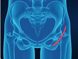 Metode Baru, Operasi Penggantian Pinggul dengan Minimal Invasif