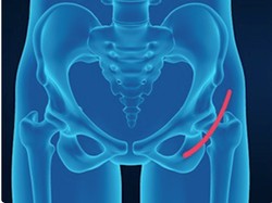 Metode Baru, Operasi Penggantian Pinggul dengan Minimal Invasif